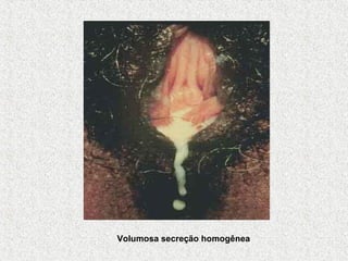 Volumosa secreção homogênea 