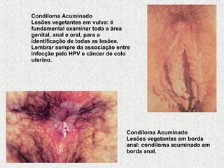 Condiloma Acuminado Lesões vegetantes em borda anal: condiloma acuminado em borda anal.   Condiloma Acuminado Lesões vegetantes em vulva: é fundamental examinar toda a área genital, anal e oral, para a identificação de todas as lesões. Lembrar sempre da associação entre infecção pelo HPV e câncer de colo uterino.   