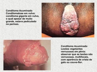 Condiloma Acuminado Condilomatose em vulva: condiloma gigante em vulva, o qual apesar de muito grande, estava pediculado no períneo.   Condiloma Acuminado Lesões vegetantes verrucosas em pênis: observar que as lesões são verrucosas, multifocais, com aparência de crista de galo ou couve-flor.   
