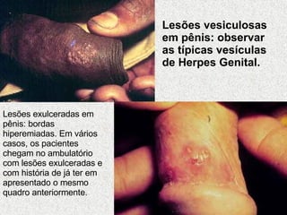 Lesões vesiculosas em pênis: observar as típicas vesículas de Herpes Genital.  Lesões exulceradas em pênis: bordas hiperemiadas. Em vários casos, os pacientes chegam no ambulatório com lesões exulceradas e com história de já ter em apresentado o mesmo quadro anteriormente.  