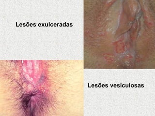 Lesões vesiculosas Lesões exulceradas 