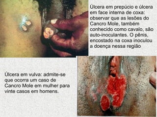 Úlcera em prepúcio e úlcera em face interna de coxa: observar que as lesões do Cancro Mole, também conhecido como cavalo, são auto-inoculantes. O pênis, encostado na coxa inoculou a doença nessa região  Úlcera em vulva: admite-se que ocorra um caso de Cancro Mole em mulher para vinte casos em homens.   