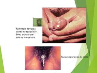 Gonorréia mplicada:
edema no testículoco,
bolsa escrotal com
volume aumentado.
Secreção purulenta na vulva
 