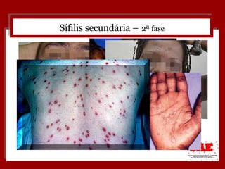Sífilis secundária –   2ª fase 