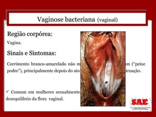 Vaginose bacteriana   (vaginal) Sinais e Sintomas: Corrimento branco-amarelado não muito intenso, cheiro ruim (“peixe podre”), principalmente depois do ato sexual ou final da menstruação. Região corpórea: Vagina. Comum em mulheres sexualmente ativas, sendo um desequilíbrio da flora  vaginal.  