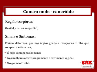 Cancro mole - cancróide Região corpórea:  Genital, anal ou anogenital; É mais comum nos homens; Nas mulheres ocorre sangramento e corrimento vaginal; Sangramento retal. Sinais e Sintomas:  Feridas dolorosas, pus nos órgãos genitais, caroços na virilha que rompem e soltam pus; 