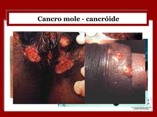 Cancro mole - cancróide 