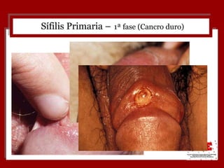 Sífilis Primaria –   1ª fase (Cancro duro) 