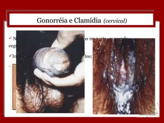 Gonorréia e Clamídia   (cervical) Na gestação, podem ser transmitidas no parto, causando cegueira no bebê; Inflamação na próstata e nos testículos; Esterilidade feminina e masculina. 