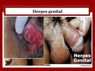 Herpes genital 