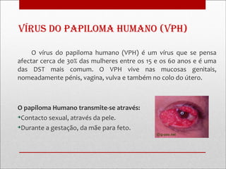vírus Do papiloma Humano (vpH)

     O vírus do papiloma humano (VPH) é um vírus que se pensa
afectar cerca de 30% das mulheres entre os 15 e os 60 anos e é uma
das DST mais comum. O VPH vive nas mucosas genitais,
nomeadamente pénis, vagina, vulva e também no colo do útero.



O papiloma Humano transmite-se através:

 Contacto sexual, através da pele.

 Durante a gestação, da mãe para feto.
 