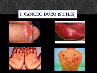 I. CANCRO DURO (SÍFILIS)
 