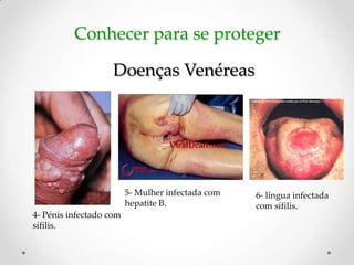 Conhecer para se proteger

                    Doenças Venéreas




                         5- Mulher infectada com   6- língua infectada
                         hepatite B.               com sífilis.
4- Pénis infectado com
sífilis.
 