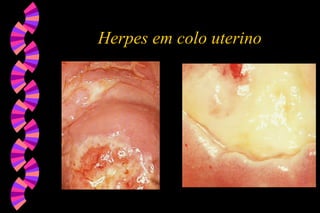 Herpes em colo uterino
 