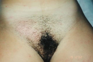 Linfadenopatia / Sífiles
 