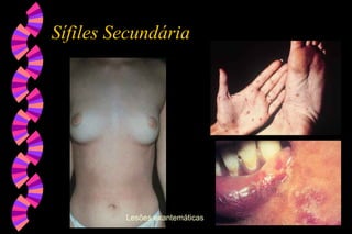 Sífiles Secundária
Lesões exantemáticas
 
