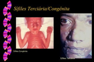 Sífiles Terciária/Congênita
Sífiles Congênita
Sífiles Terciária
 