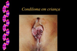 Condiloma em criança
 