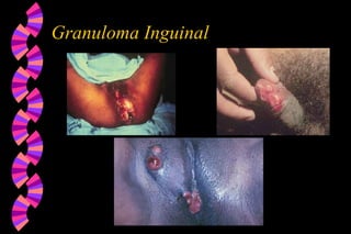 Granuloma Inguinal
 