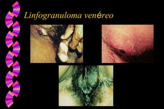 Linfogranuloma venéreo
 