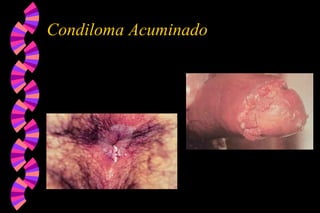 Condiloma Acuminado
 