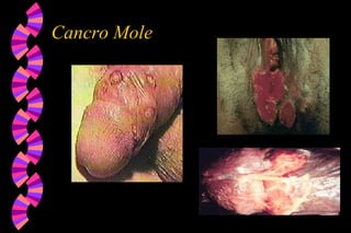 Cancro Mole
 