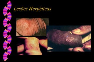 Lesões Herpéticas
 