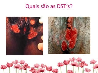 Quais são as DST’s?
 