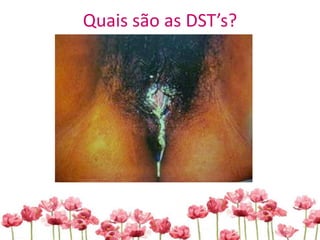 Quais são as DST’s?
 