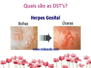 Quais são as DST’s?
 