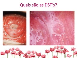 Quais são as DST’s?
 