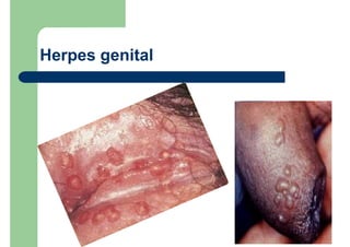 Herpes genital
 