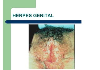 HERPES GENITAL
 