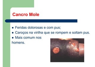 Cancro Mole
Feridas dolorosas e com pus;
Caroços na virilha que se rompem e soltam pus.
Mais comum nos
homens.
 