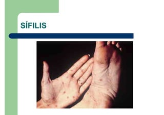 SÍFILIS
 