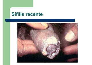 Sífilis recente
 