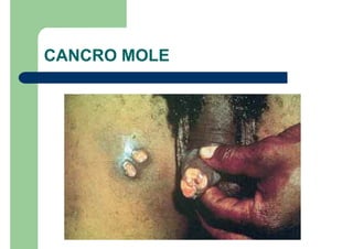 CANCRO MOLE
 