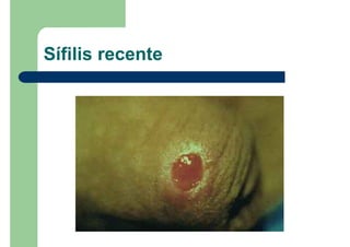 Sífilis recente
 