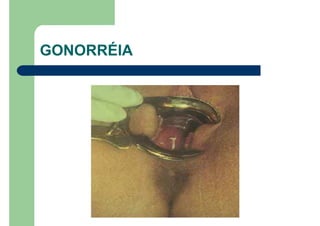 GONORRÉIA
 