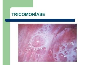 TRICOMONÍASE
 