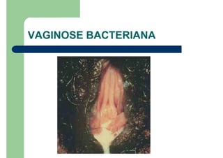 VAGINOSE BACTERIANA
 