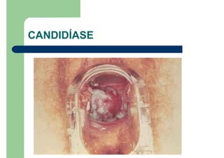 CANDIDÍASE
 