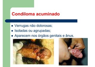 Condiloma acuminado
Verrugas não dolorosas;
Isoladas ou agrupadas;
Aparecem nos órgãos genitais e ânus.
 