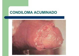 CONDILOMA ACUMINADO
 