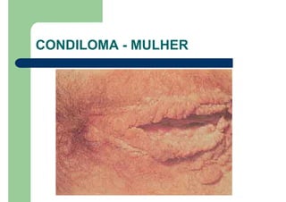 CONDILOMA - MULHER
 