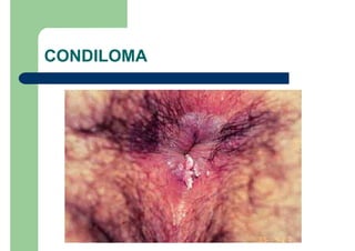 CONDILOMA
 