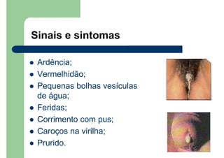 Sinais e sintomas
Ardência;
Vermelhidão;
Pequenas bolhas vesículas
de água;
Feridas;
Corrimento com pus;
Caroços na virilha;
Prurido.
 