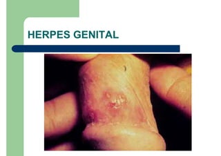 HERPES GENITAL
 