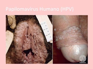 Papilomavírus Humano (HPV)
• Evoluções da infecção
– Cura espontânea;
– Persistência do vírus associada a citologia normal;
– Alterações celulares transitórias;
– Alterações celulares que, mesmo persistentes, não
progridem;
– Alterações celulares que evoluem para carcinoma.
Condiloma acuminado é a lesão que
acomete a vulva e a pele do períneo e,
menos no colo.
121
 