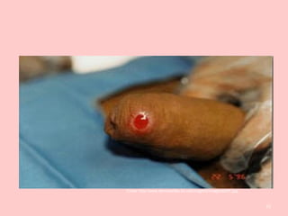 23
Fonte: http://www.eliminasifilis.kit.net/imagens/imagens/sif1.jpg
 